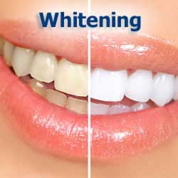 Learn about Tooth Whitening. Teeth Whitening