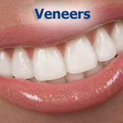 Learn about Dental Veneers. Veneers